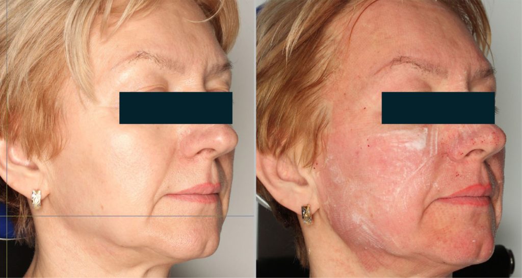 Foto van het huidoppervlak met normaal licht vóór de behandeling. Foto van het huidoppervlak met gepolariseerd licht na de behandeling met een crème. Zichtbaar erytheem.