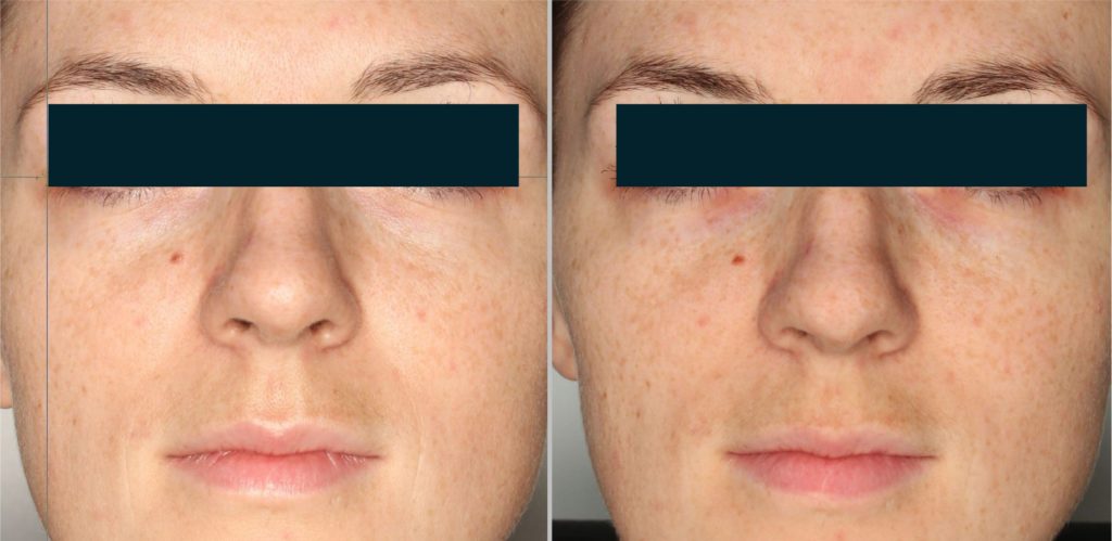 Foto van het huidoppervlak met normaal licht vóór de behandeling. Foto van het huidoppervlak met gepolariseerd licht en melanine correctiefilter, vóór de behandeling.