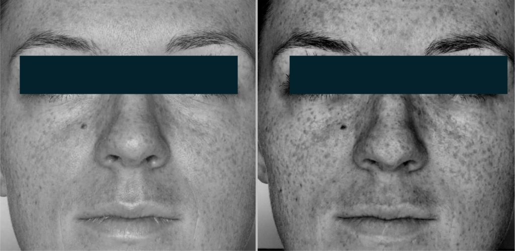Foto van het huidoppervlak met normaal licht en melanine correctiefilter, vóór de behandeling. Foto van het huidoppervlak met gepolariseerd licht en melanine correctiefilter, vóór de behandeling. De aanwezigheid van sproeten is duidelijk zichtbaar.