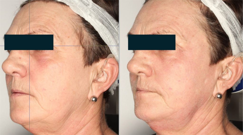 Foto van de persoon vóór de behandeling. Foto van de persoon na de behandeling. De met laser bewerkte zones zijn duidelijk zichtbaar.