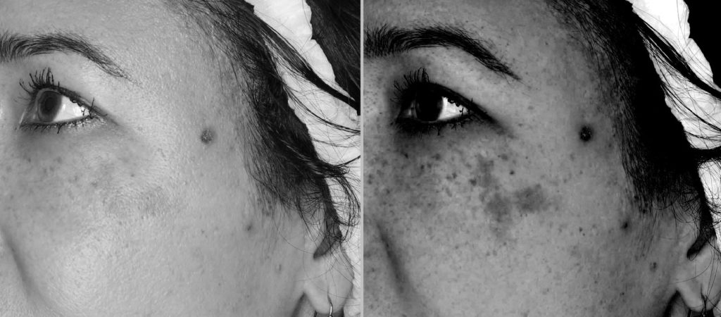 Foto van het huidoppervlak met normaal licht en melanine correctiefilter, vóór de behandeling. Foto van het huidoppervlak met gepolariseerd licht en melanine correctiefilter, vóór de behandeling.