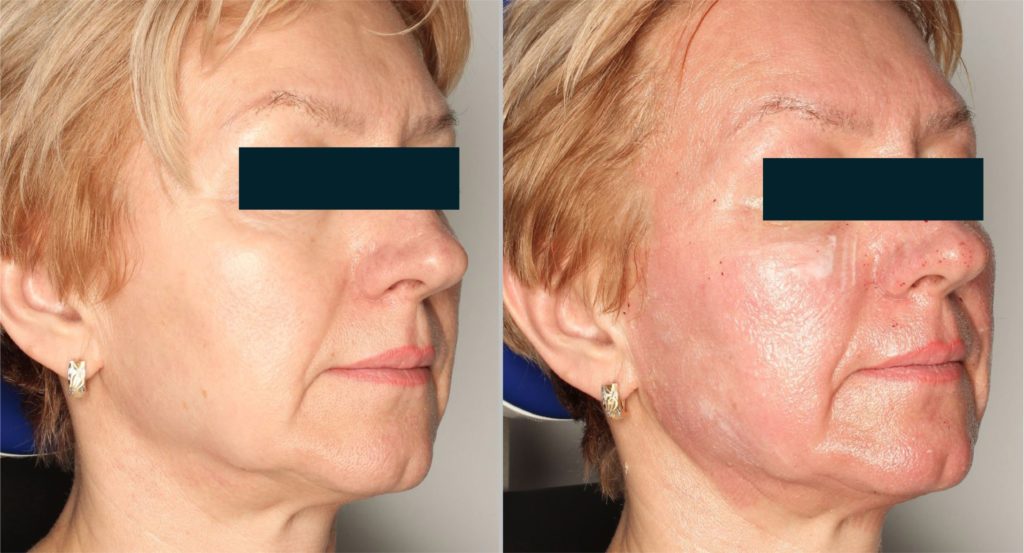 Foto van het huidoppervlak met normaal licht vóór de behandeling. Foto van het huidoppervlak met normaal licht na de behandeling met een crème. Zichtbaar erytheem.